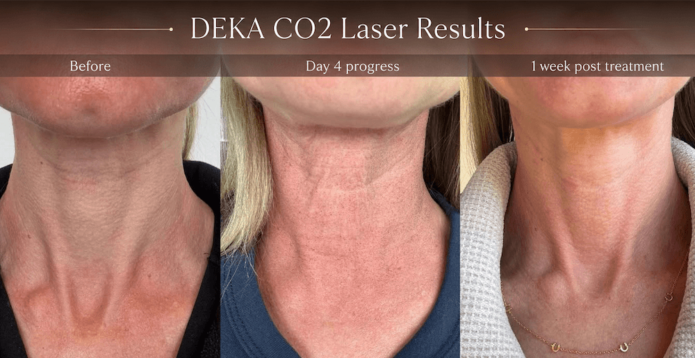 DEKA CO2 laser before and progress result visual for RAVE Clinics